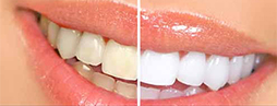 Teeth Whitening